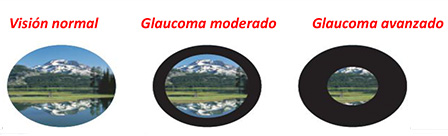 comparativa-glaucoma